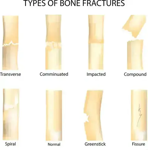 Injuries: Bone Fracture Types